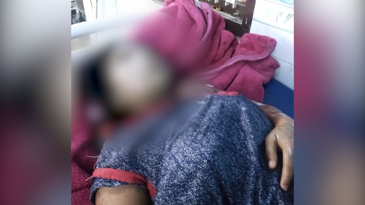 बिहार में छपाक :  एकतरफा प्यार में सनकी युवक ने घर में सो रही युवती को तेजाब से नहलाया, हालत नाजुक