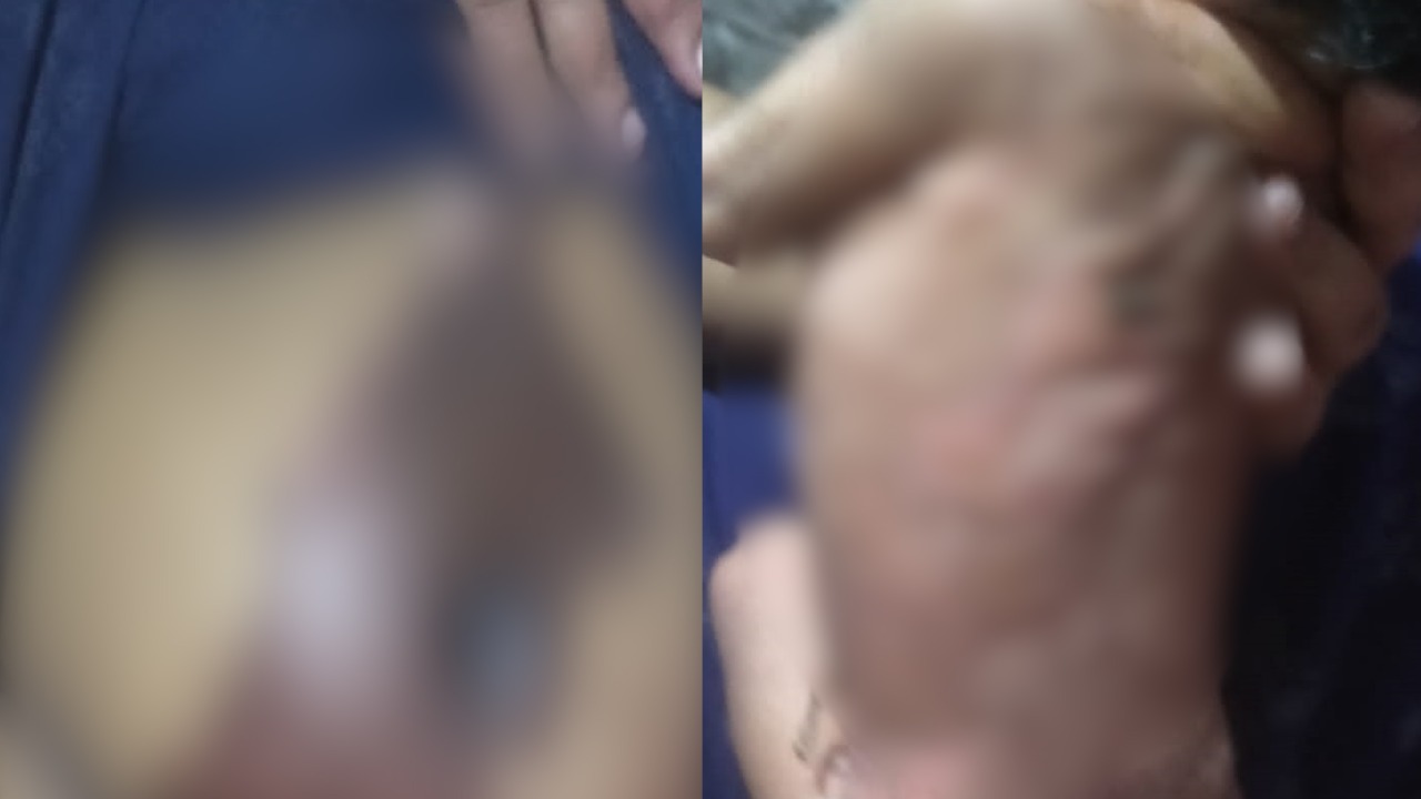 प्रसव के बाद एसिड से कर दी जच्चा-बच्चा की मालिश, नवजात गंभीर