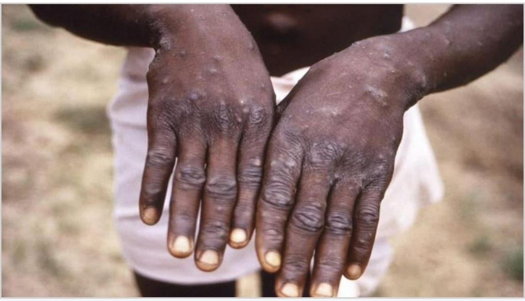 WHO ने बुलाई आपात बैठक, 39 देशों में मंकीपॉक्स के 1600 केस