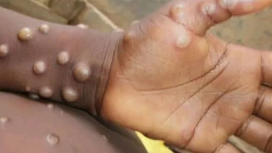 औरंगाबाद में मंकीपॉक्स ने दी दस्तक, संदिग्ध मरीज के मिलने से मचा हड़कंप