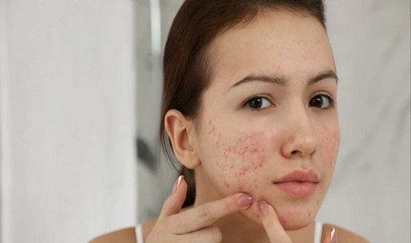 चेहरे की पिंपल्स और दाग से हैं परेशान ! इस खबर में मिलेगा सटीक समाधान  