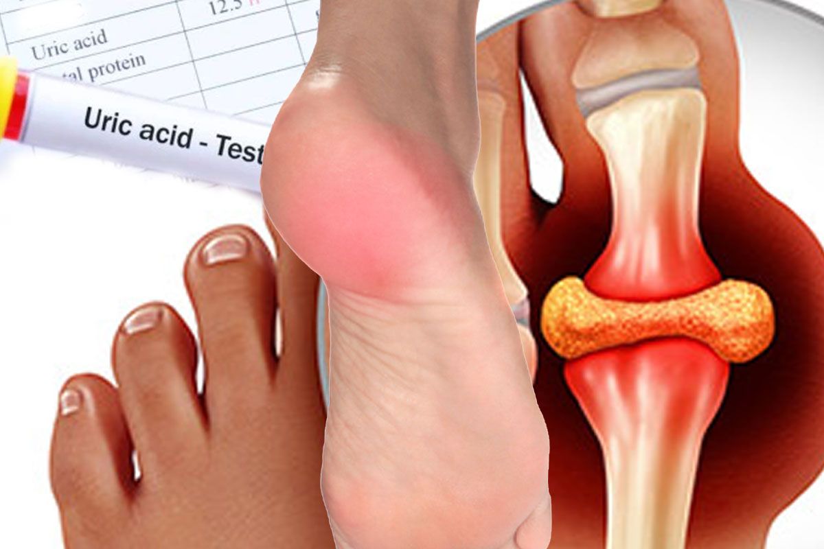 अगर यूरिक एसिड आपको भी करता है परेशान, तो इन फलों को अपने खान -पान में करें शामिल, मिलेगी राहत 