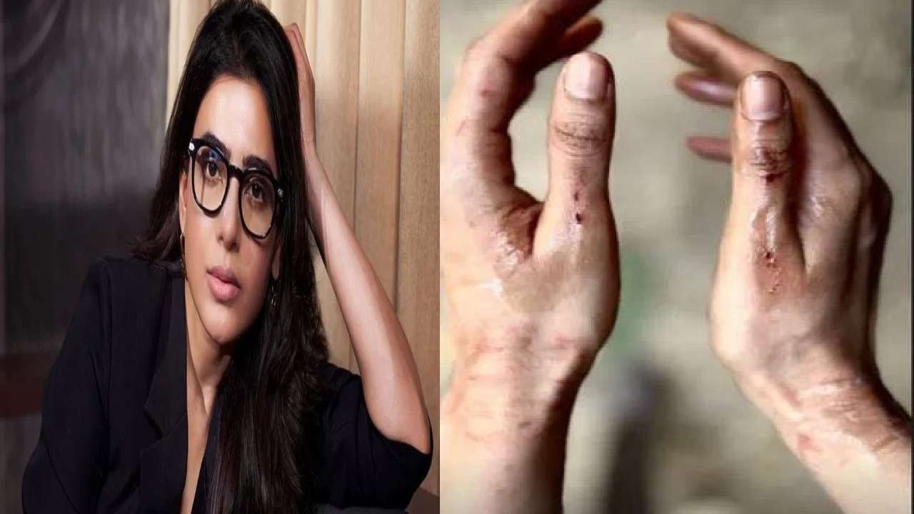 शूटिंग के दौरान साउथ ऐक्ट्रिस सामंथा हुई घायल, लोगों के साथ शेयर की तस्वीर