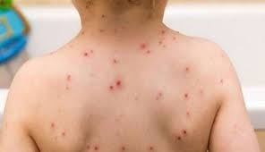 WHO की रिपोर्ट के बाद झारखंड में हड़कंप, मुंबई के बाद झारखंड में मिले खसरा का मामला, एक ही परिवार के तीन बच्चों की हुई मौत