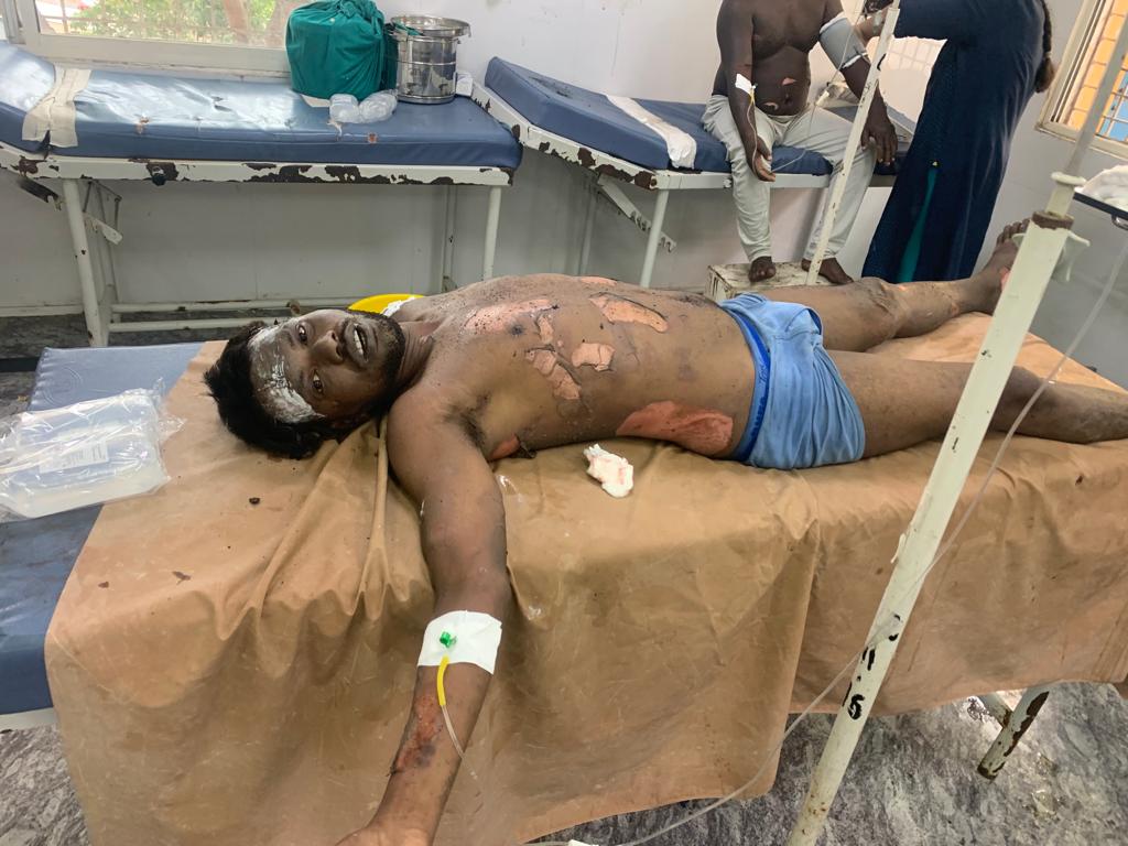 हैदराबाद में बोकारो का युवक गैस सिलेंडर फटने से हुआ घायल, काम की तलाश में हैदराबाद गया था युवक  