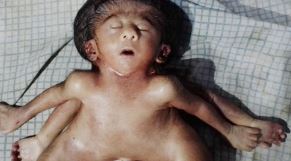 चार-चार हाथ-पैरों के साथ जन्मी अजीबो-गरीब बच्ची, मिनट बाद ही तोड़ा दम, जानें क्या है डॉक्टरों की राय   