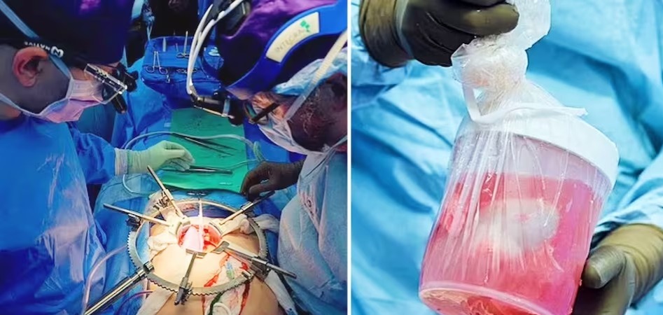 OMG इंसानी शरीर में सूअर की किडनी, अब इंसान को बचाने में जानवरों के अंग का किया जाएगा इस्तेमाल!