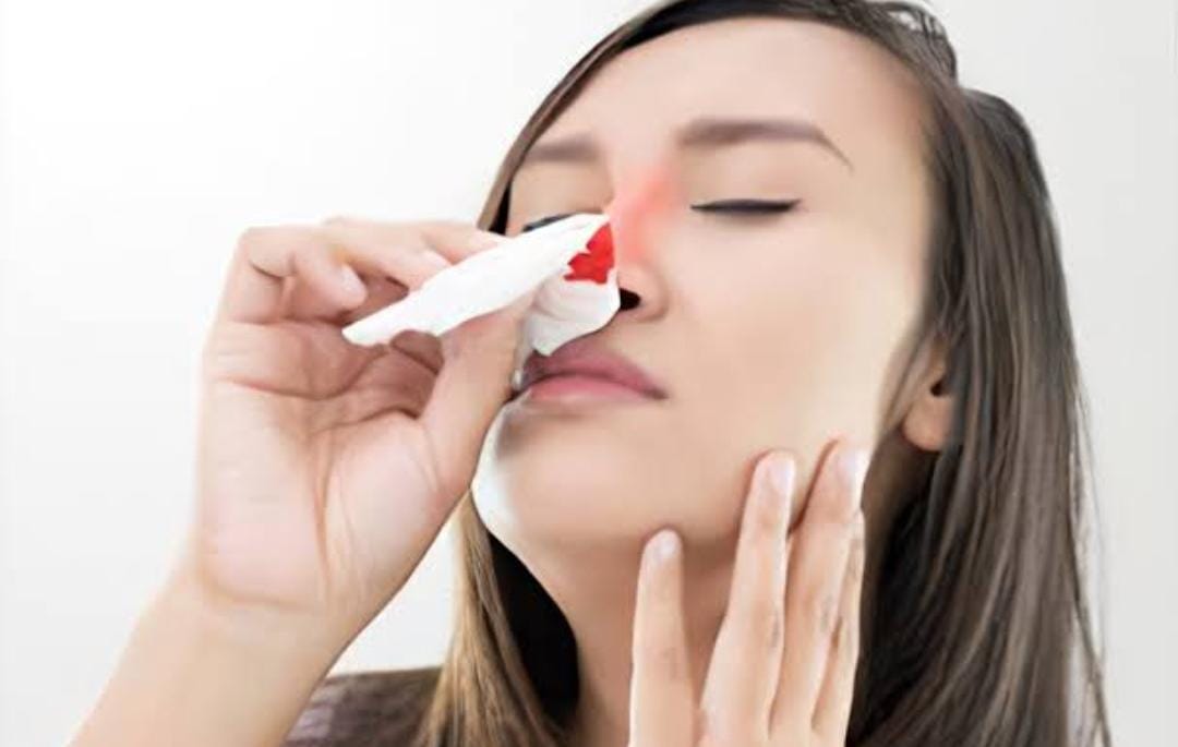 Health Post: गर्मियों में अचानक नाक से होने लगे ब्लीडिंग, तो अपनायें ये घरेलू नुस्खे, मिलेगी नकसीर से राहत  
