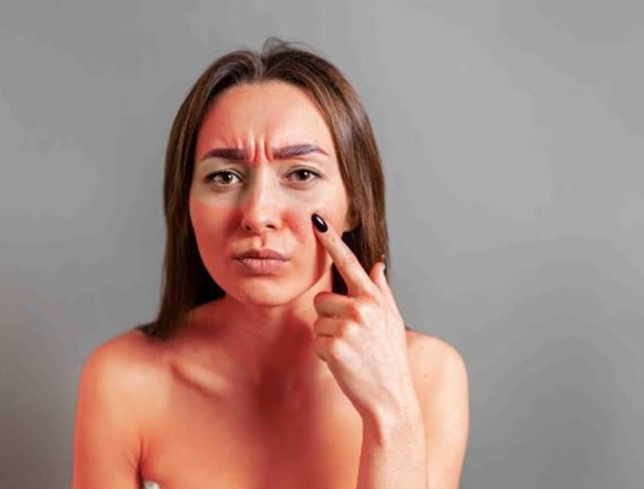 गर्मियों में बढ़ चुका है सनबर्न का खतरा, तो इन 4 घरेंलू उपायों से बचाये अपनी त्वचा 