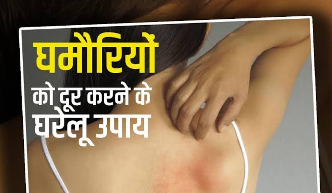 गर्मियों में घमौरी से हैं परेशान, तो आजमाएं ये उपाय, मिलेगी राहत