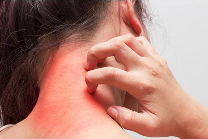 बरसात में दाद,खाद और खुजली से हो गये हैं परेशान, तो इन तरीकों से करें बचाव 