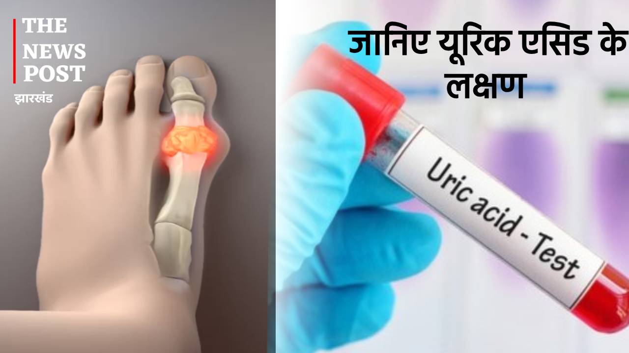 जोड़ों के दर्द हो सकते हैं यूरिक एसिड के लक्षण, जानिए कैसे घरेलू नुस्खों से कर सकते हैं इसे कंट्रोल