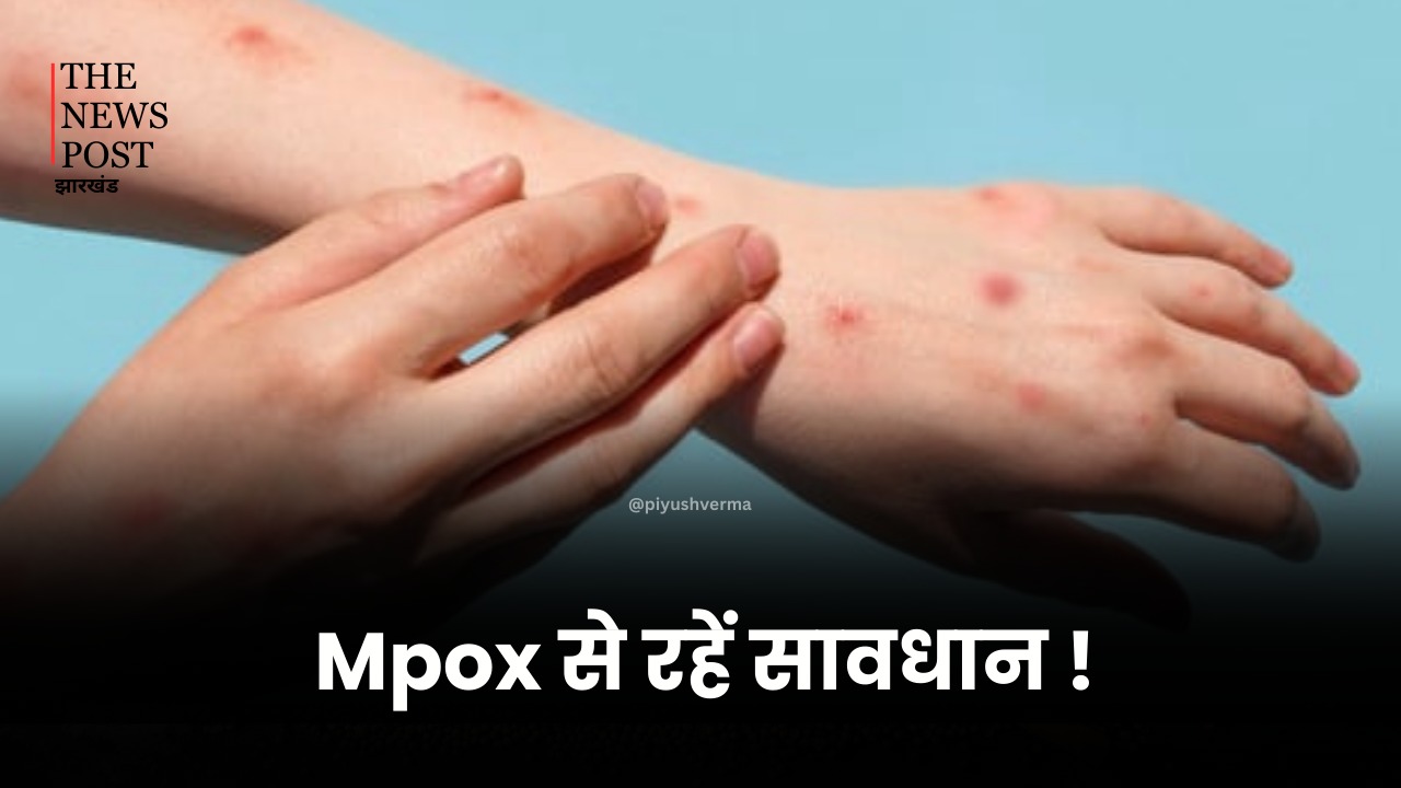 अगर ये लक्षण दिखे तो हो जाएं सावधान! Mpox का हो सकता है खतरा, देखिए क्या कहते हैं डॉक्टर