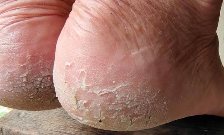 Tips and Tricks:सर्दियों में फटी एड़ियां करती है परेशान, तो अपनाएं ये आसान से टिप्स, जल्दी मिलेगी राहत