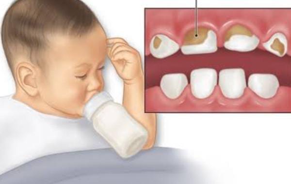 Health Tips:आपके बच्चों के दांतो में भी है मिल्क बॉटल कैविटी की समस्या तो ऐसे करें बचाव