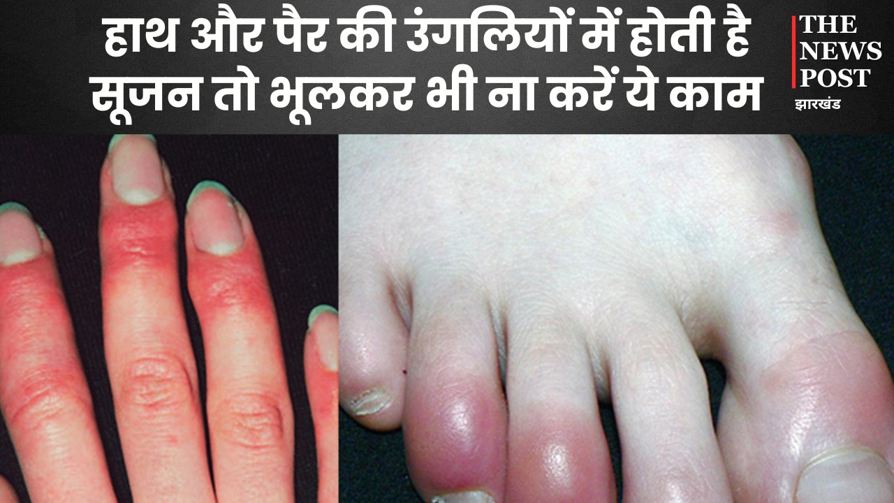 सर्दियों में हाथ-पैर की उंगलियों में क्यों आ जाती है सूजन, जानें ठीक करने के क्या हैं घरेलू उपचार