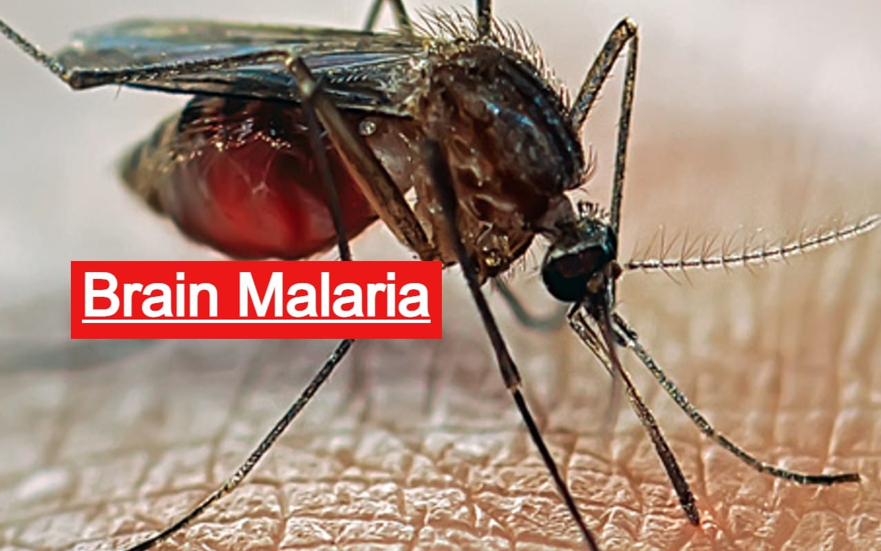 साहिबगंज में ब्रेन मलेरिया से पांच पहाड़िया बच्चों की मौत, जानिए क्या हैं इसके लक्षण और कैसे करें बचाव