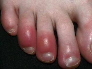 ठंड बढ़ते ही अगर आपके हाथ-पैर की उंगलियों में भी हो जाती है सूजन तो इस उपाय से तुरंत मिलेगी राहत