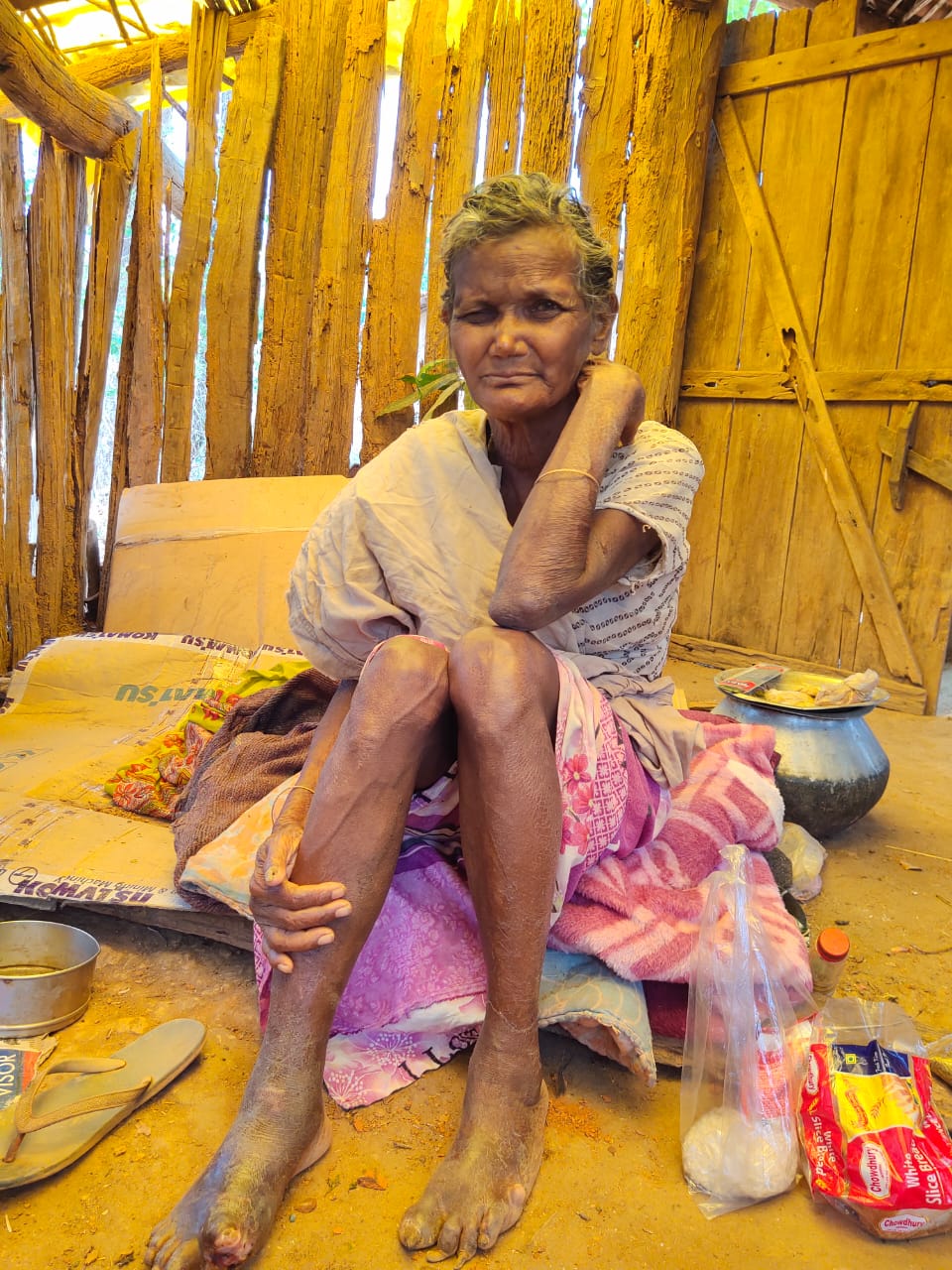 सारंडा में दर्जनों लोगों में कुष्ठ रोग के प्रारंभिक लक्ष्ण मिले, एक महिला में रोग की पुष्टि  